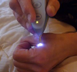 laser-acupuncture