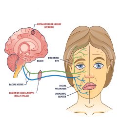 טיפול בשיתוק של הפנים (Bell's Palsy) בדיקור סיני